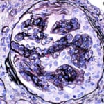 Jones Method for Kidney