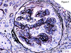 Jones Method for Kidney