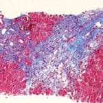 Carstairs Method for Fibrin and Platelets