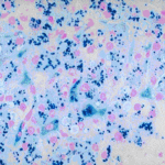 Prussian Blue Method for Hemosiderin